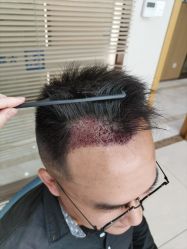 -大麦微针植发丨全国连锁