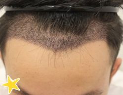 -大麦微针植发丨全国连锁