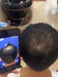 -碧莲盛·不剃发植发