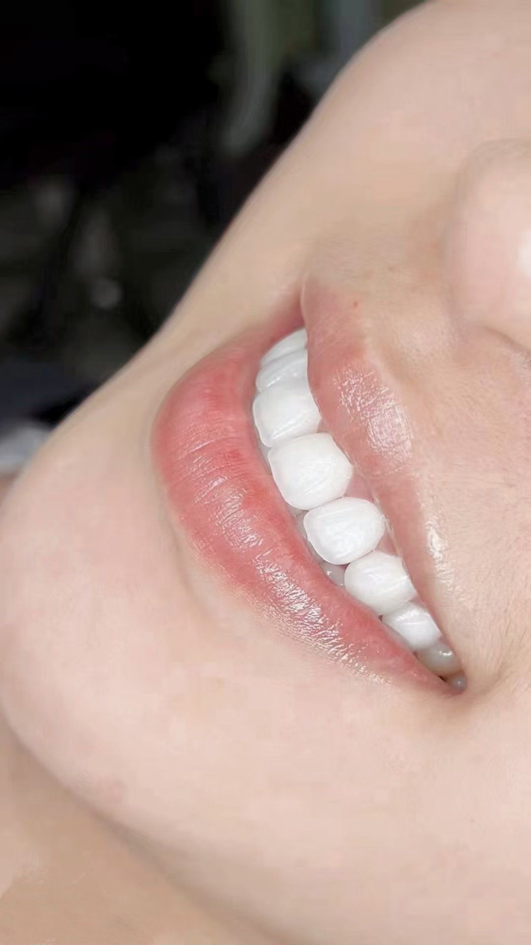 亮白牙齿自然闪耀