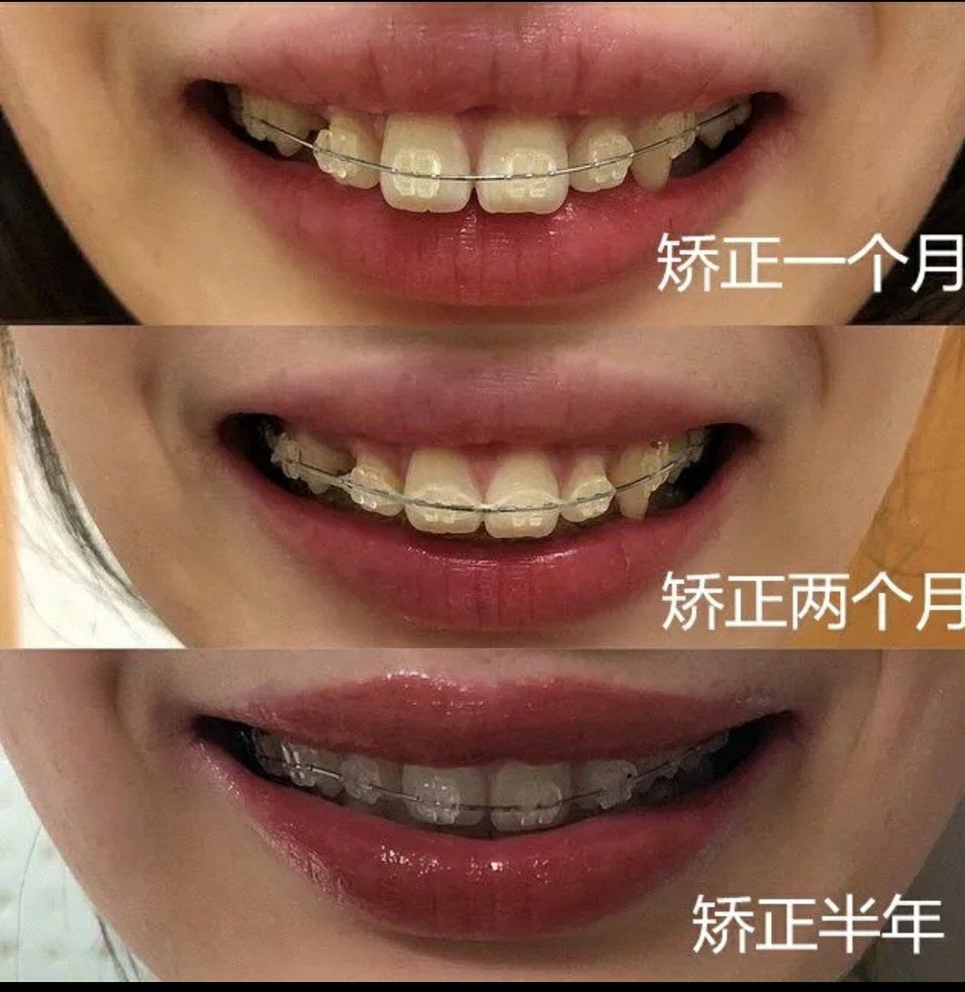 陶瓷自锁矫正半年后的变化