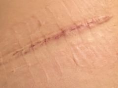 -杭州仁易堂中医康复医院疤痕修复