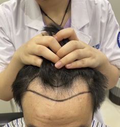 -碧莲盛·不剃发植发