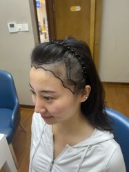 -大麦微针植发全国连锁