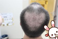 点击看大图 -大麦微针植发丨全国连锁