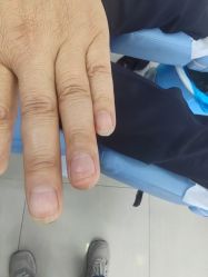 -德哥灰指甲脚气甲沟炎跖疣护理