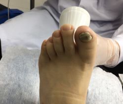 -派恩宜灰指甲鸡眼嵌甲手足癣