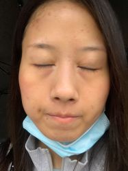 体验后-圣嘉新医疗美容医院