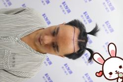 -大麦微针植发丨全国连锁