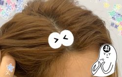 -大麦微针植发全国连锁