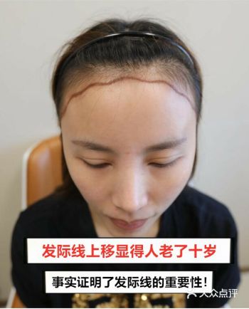 发际线上移显得人老了十岁！  事实证明了发际线的重要性！