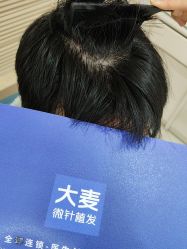 -大麦微针植发丨全国连锁