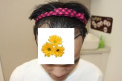-大麦微针植发丨全国连锁