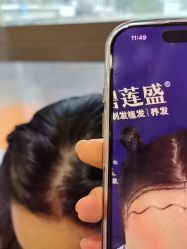 -碧莲盛·不剃发植发