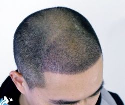 -大麦微针植发丨全国连锁