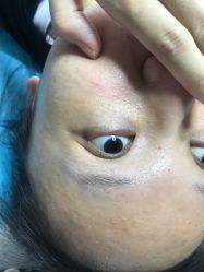 -爱莎扁平疣·汗管瘤·斑痣中心