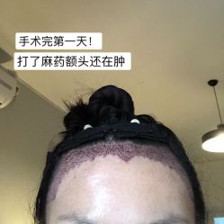 -碧莲盛·不剃发植发