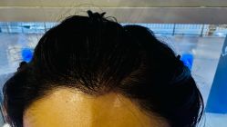 -碧莲盛·不剃发植发