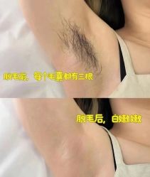 -薇兰专业脱毛连锁机构