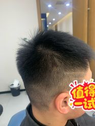 体验后-大麦微针植发全国连锁