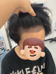 -大麦微针植发全国连锁