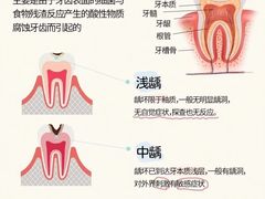 -上海仁爱医院口腔科 · 种植