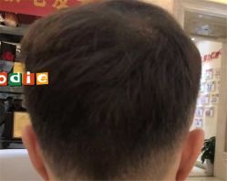 -大麦微针植发全国连锁