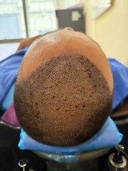 -碧莲盛·不剃发植发