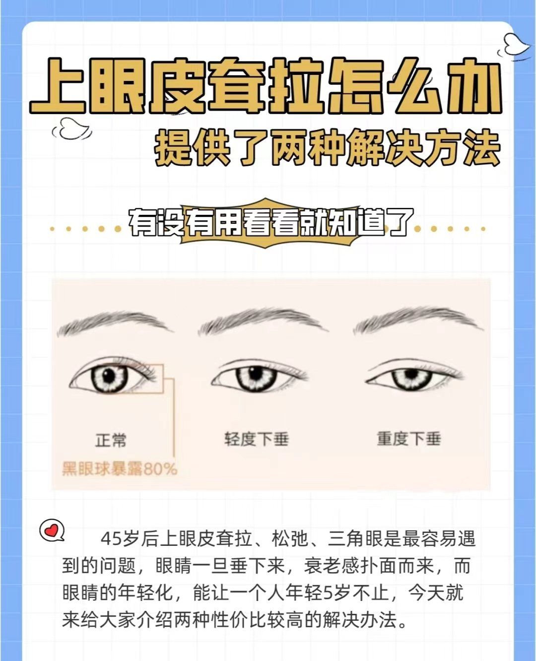 上眼皮松弛耷拉?这两种方法看你适合哪种