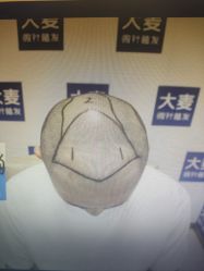 体验前-大麦微针植发丨全国连锁