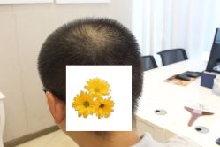 -大麦微针植发丨全国连锁