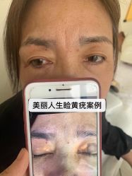 -美丽人生祛斑扁平疣汗管瘤中心