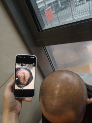 -碧莲盛·不剃发植发