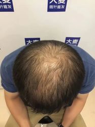 点击看大图 -大麦微针植发丨全国连锁