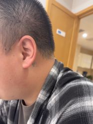 -大麦微针植发丨全国连锁
