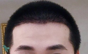 -大麦微针植发丨全国连锁