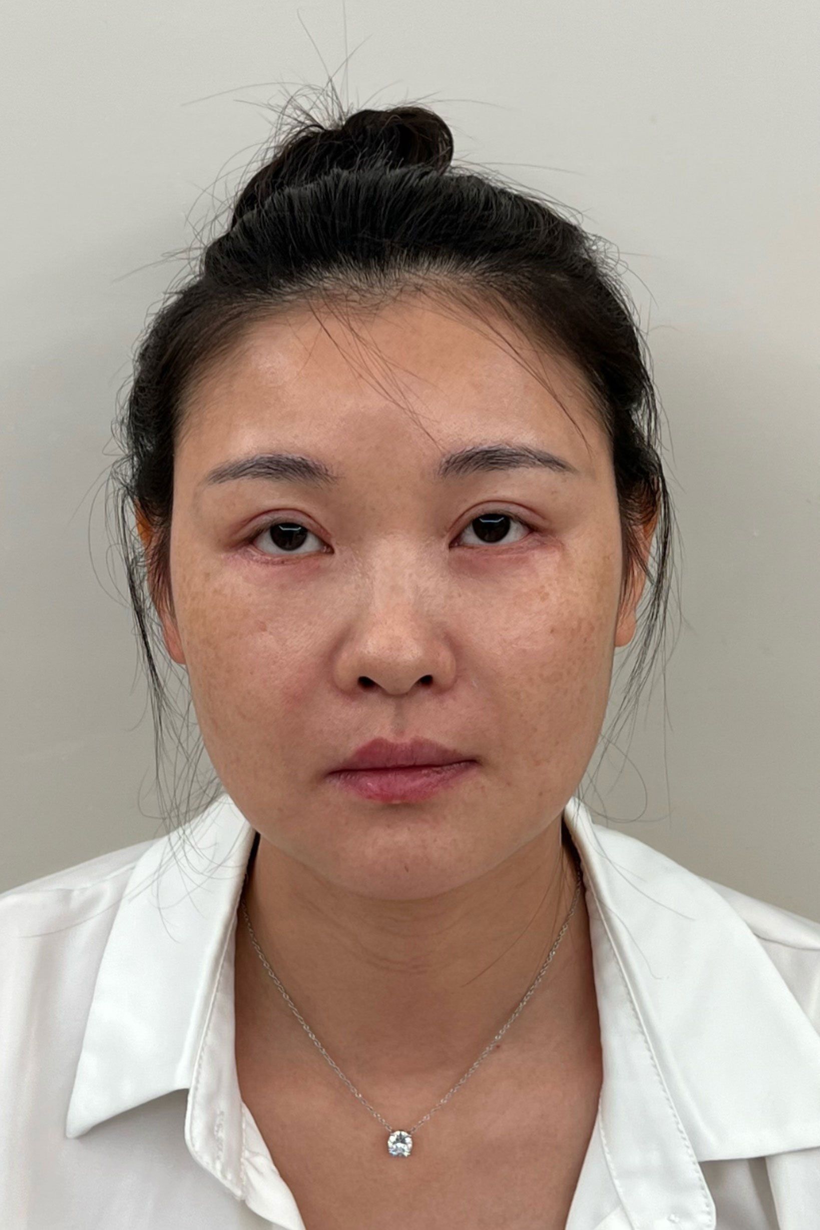 【乔雅登玻尿酸】体验10天后效果分享