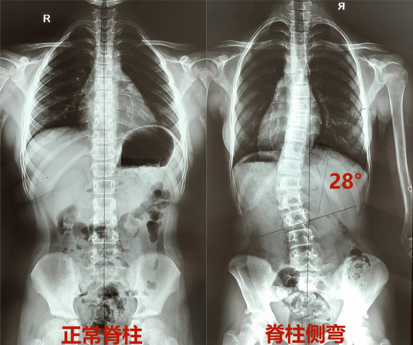 脊柱侧弯系列评估5