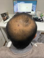点击看大图 -碧莲盛·不剃发植发