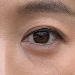 -广州健丽·去眼袋医疗美容机构