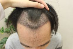 -大麦微针植发丨全国连锁