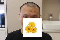 -大麦微针植发丨全国连锁