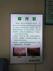 -德哥灰指甲脚气甲沟炎跖疣护理