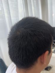 -大麦微针植发丨全国连锁