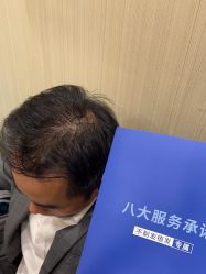 -碧莲盛·不剃发植发