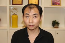 点击看大图 -大麦微针植发丨全国连锁