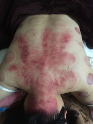 -悦艾堂·中医拔罐减肥·美体艾灸连锁