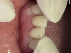-上海仁爱医院口腔科 · 种植