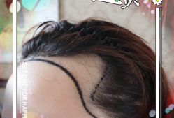 -大麦微针植发全国连锁