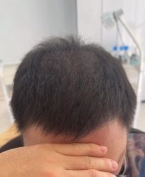-大麦微针植发丨全国连锁